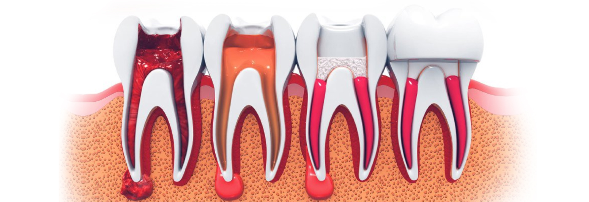 Best Tooth Replacement in Chembur