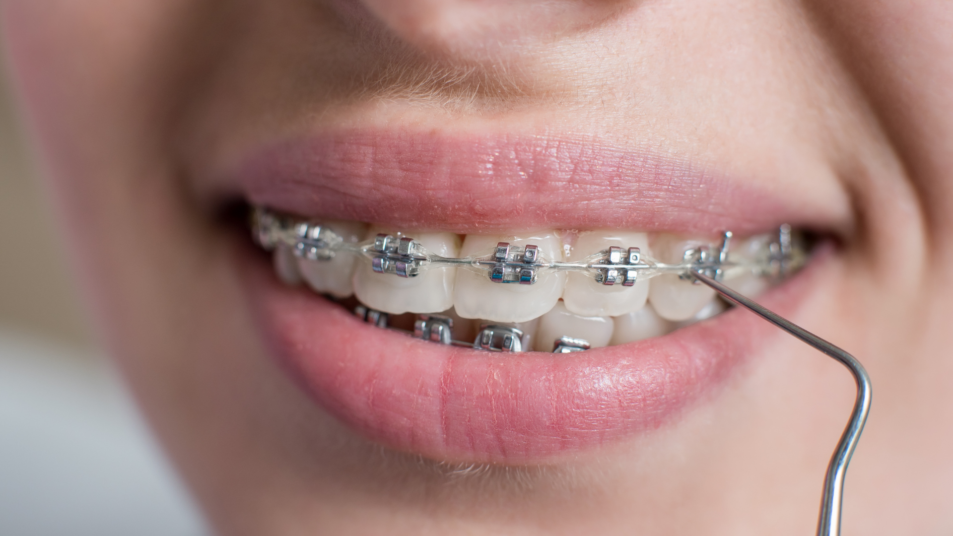 Metal Braces in Chembur