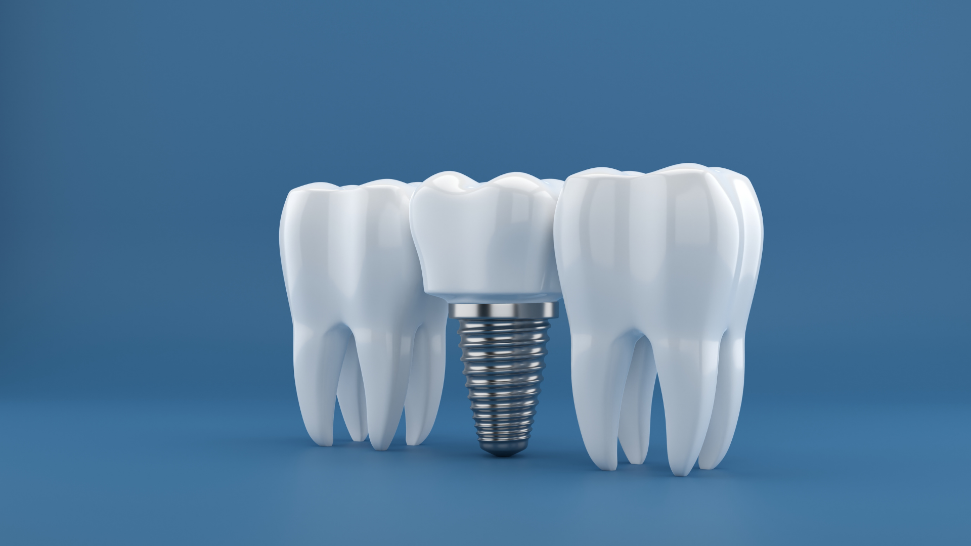 Dental implants in Chembur procedure at Loop Dental