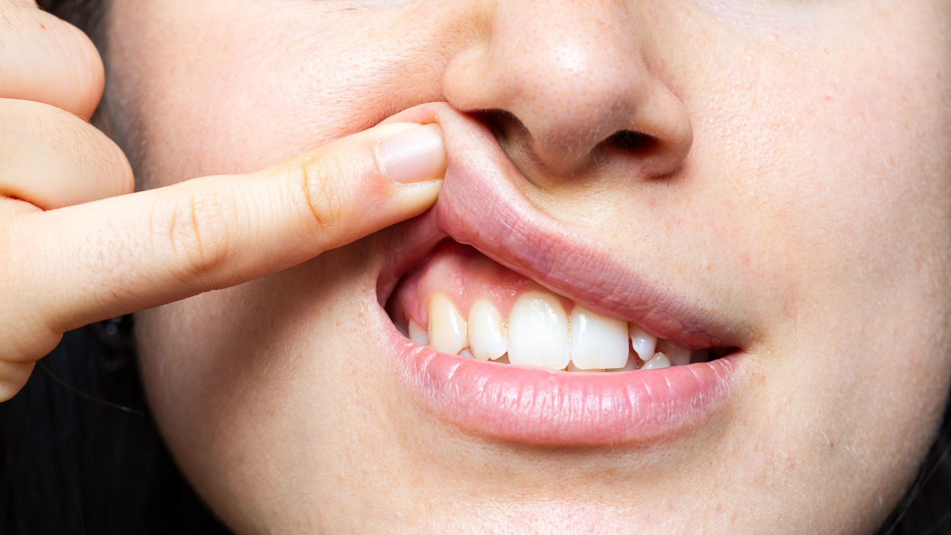 Gums Surgery in Chembur